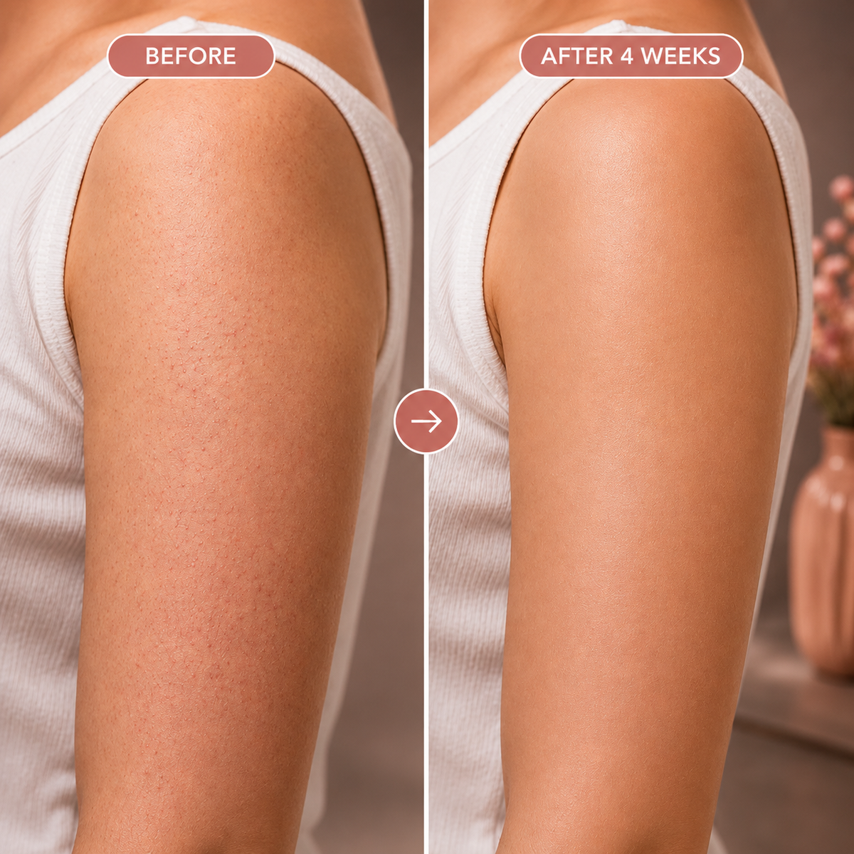 Keratosis Pilaris Treatment – Triple Acid – Hydrating – For Sensitive Skin